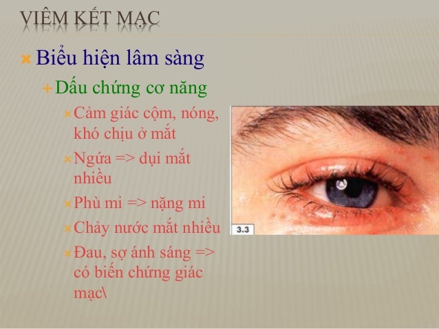 Biểu hiện của viêm kết mạc mắt